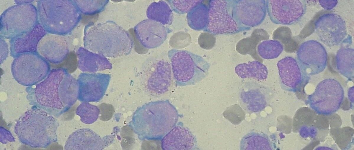 NEJM：完全缓解率翻倍！艾伯维/罗氏重磅BCL2抑制剂组合疗法达到3期临床终点