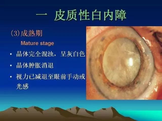 03.02《标点健康微讲堂》精彩回顾—白内障离你有多远!