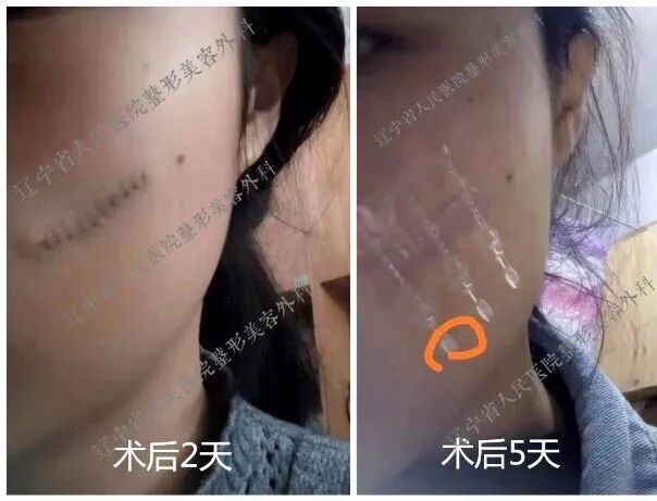 为什么要用皮肤吻合器手术后终于不用缝针啦！皮肤“拉链”，一拉就好，不留疤_https://www.jmylbn.com_新闻资讯_第10张