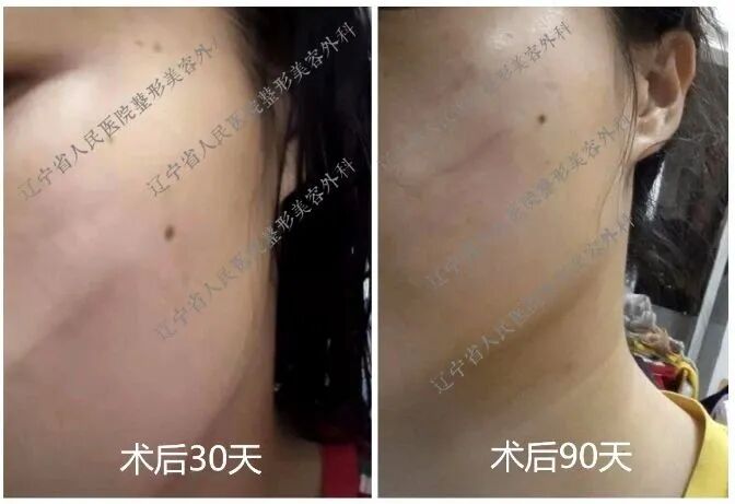 为什么要用皮肤吻合器手术后终于不用缝针啦！皮肤“拉链”，一拉就好，不留疤_https://www.jmylbn.com_新闻资讯_第11张