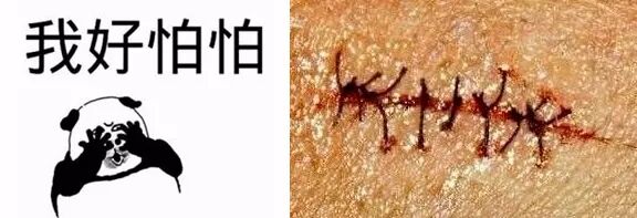 为什么要用皮肤吻合器手术后终于不用缝针啦！皮肤“拉链”，一拉就好，不留疤_https://www.jmylbn.com_新闻资讯_第4张