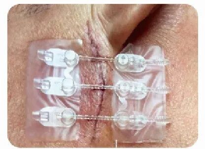 为什么要用皮肤吻合器手术后终于不用缝针啦！皮肤“拉链”，一拉就好，不留疤_https://www.jmylbn.com_新闻资讯_第15张