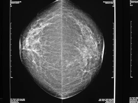 乳腺机为什么叫钼靶健康科普｜乳腺钼靶机让乳腺癌无处可藏！_https://www.jmylbn.com_新闻资讯_第9张