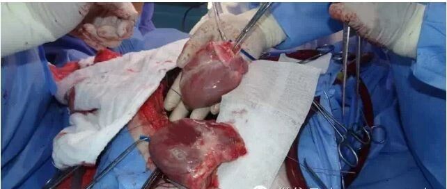 全球首例！他移植了一只猪的心脏，并且活下来了！