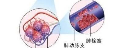 护士早读 | 肺栓塞的观察与护理，做好这些才是合格的护士