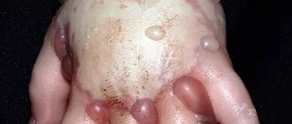 触目惊心！一例静滴药物外渗造成的严重并发症！