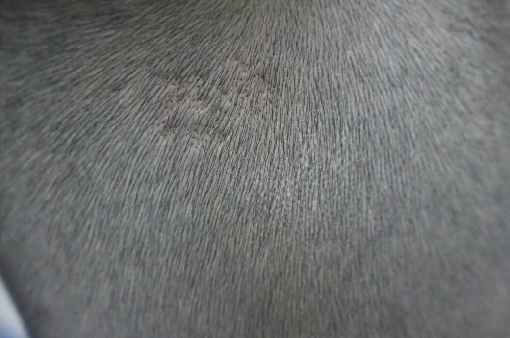 脱发竟会传染给家人？头皮出现这种症状要小心了……