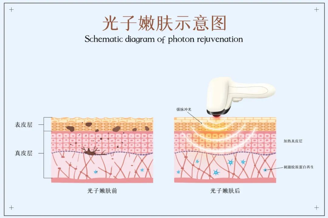 痘印心得经验_痘印心得经验_痘印心得经验