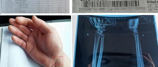郑大一附院又出事：9名手术患者使用的微血管吻合器“消失”涉事医生停职调查