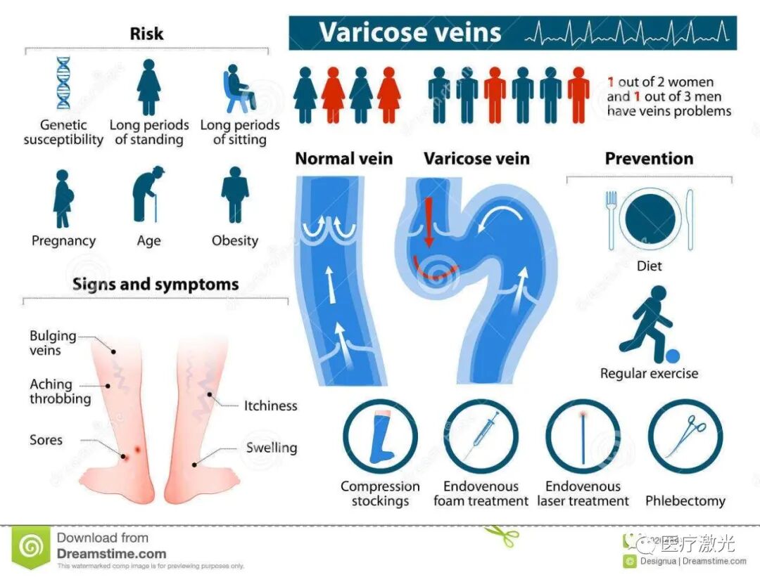 光纤什么手术【激光微创】静脉曲张激光微创手术操作流程_https://www.jmylbn.com_新闻资讯_第3张