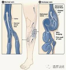 光纤什么手术【激光微创】静脉曲张激光微创手术操作流程_https://www.jmylbn.com_新闻资讯_第1张