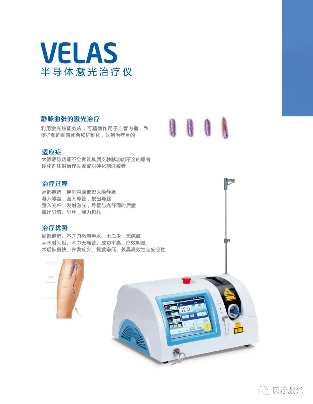 光纤什么手术【激光微创】静脉曲张激光微创手术操作流程_https://www.jmylbn.com_新闻资讯_第5张