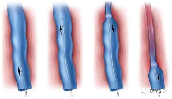 光纤什么手术【激光微创】静脉曲张激光微创手术操作流程_https://www.jmylbn.com_新闻资讯_第2张