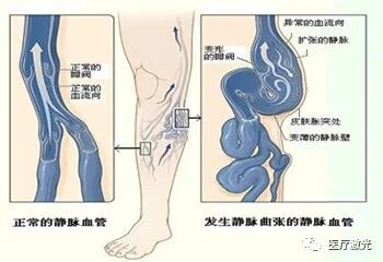 980属于什么激光【血管外科】静脉曲张不可怕，980nm激光搞定它!-上海聚慕医疗器械有限公司