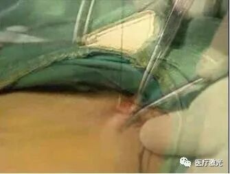 光纤什么手术【激光微创】静脉曲张激光微创手术操作流程_https://www.jmylbn.com_新闻资讯_第8张