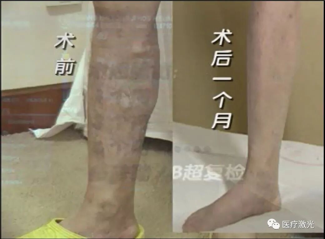 光纤什么手术【激光微创】静脉曲张激光微创手术操作流程_https://www.jmylbn.com_新闻资讯_第14张