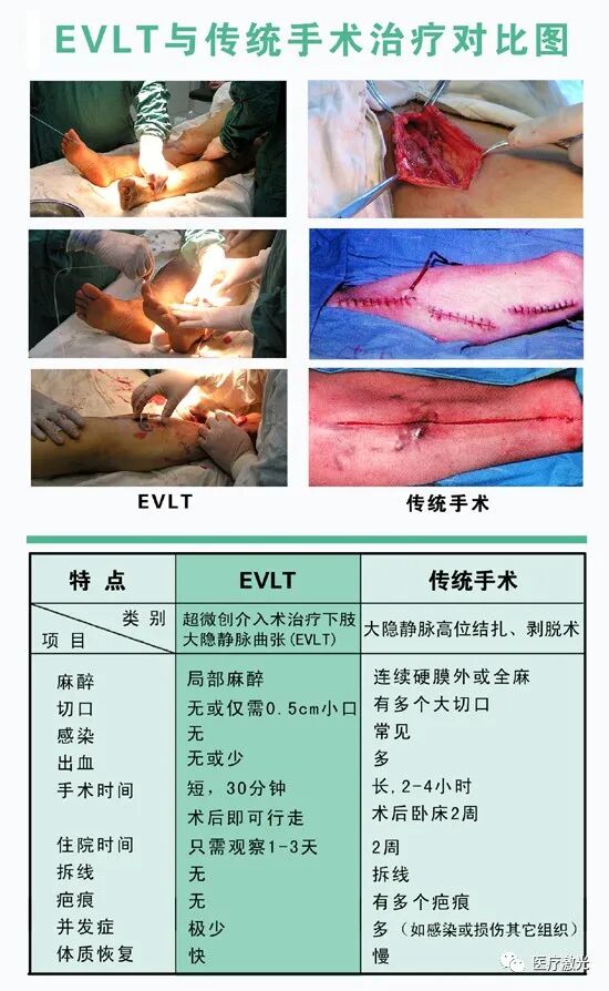 光纤什么手术【激光微创】静脉曲张激光微创手术操作流程_https://www.jmylbn.com_新闻资讯_第4张
