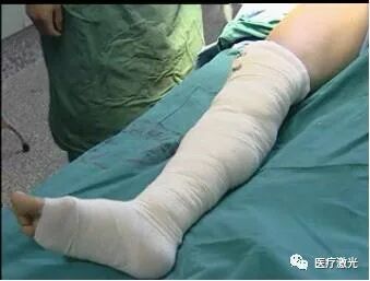 光纤什么手术【激光微创】静脉曲张激光微创手术操作流程_https://www.jmylbn.com_新闻资讯_第11张
