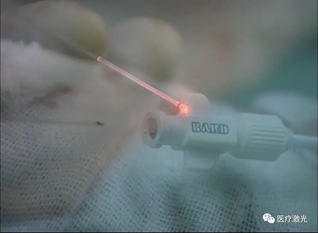 光纤什么手术【激光微创】静脉曲张激光微创手术操作流程_https://www.jmylbn.com_新闻资讯_第9张