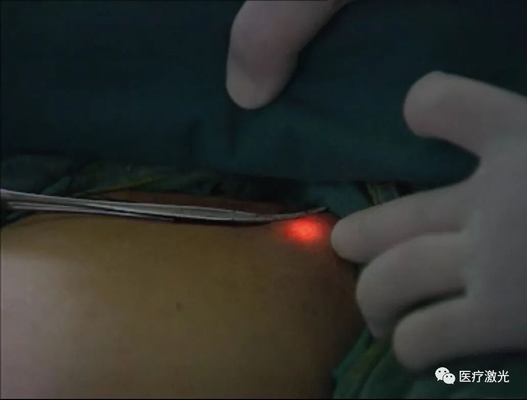 光纤什么手术【激光微创】静脉曲张激光微创手术操作流程_https://www.jmylbn.com_新闻资讯_第10张