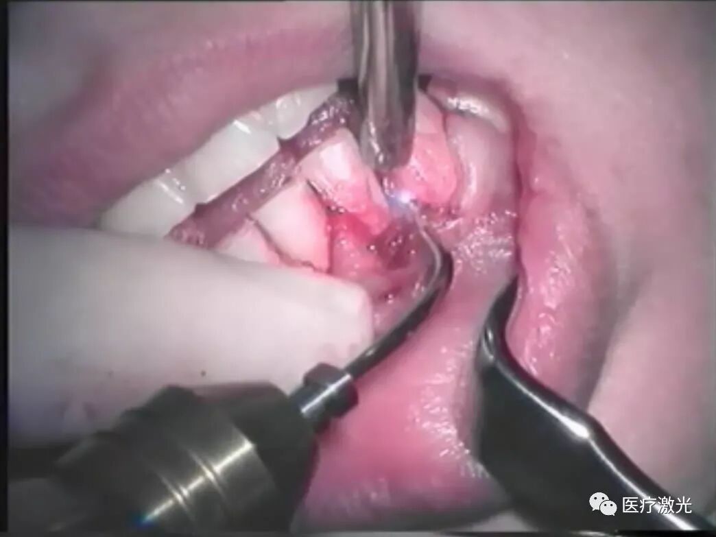 口腔激光怎么治疗【病例分享】激光在口腔软组织治疗中的作用_https://www.jmylbn.com_新闻资讯_第4张