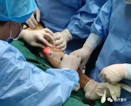 光纤什么手术【激光微创】静脉曲张激光微创手术操作流程_https://www.jmylbn.com_新闻资讯_第15张