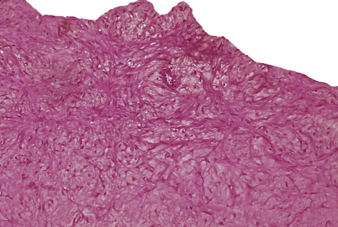 动脉钳怎么用动脉重度钙化导丝无法通过 针具技术超补救策略_https://www.jmylbn.com_新闻资讯_第30张