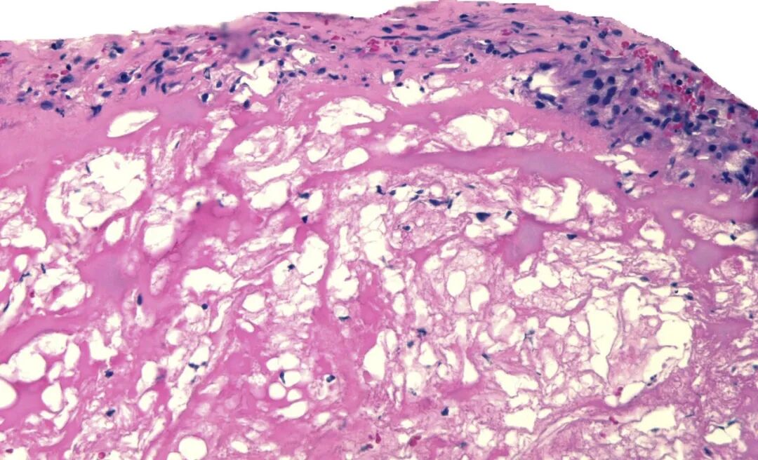 动脉钳怎么用动脉重度钙化导丝无法通过 针具技术超补救策略_https://www.jmylbn.com_新闻资讯_第28张