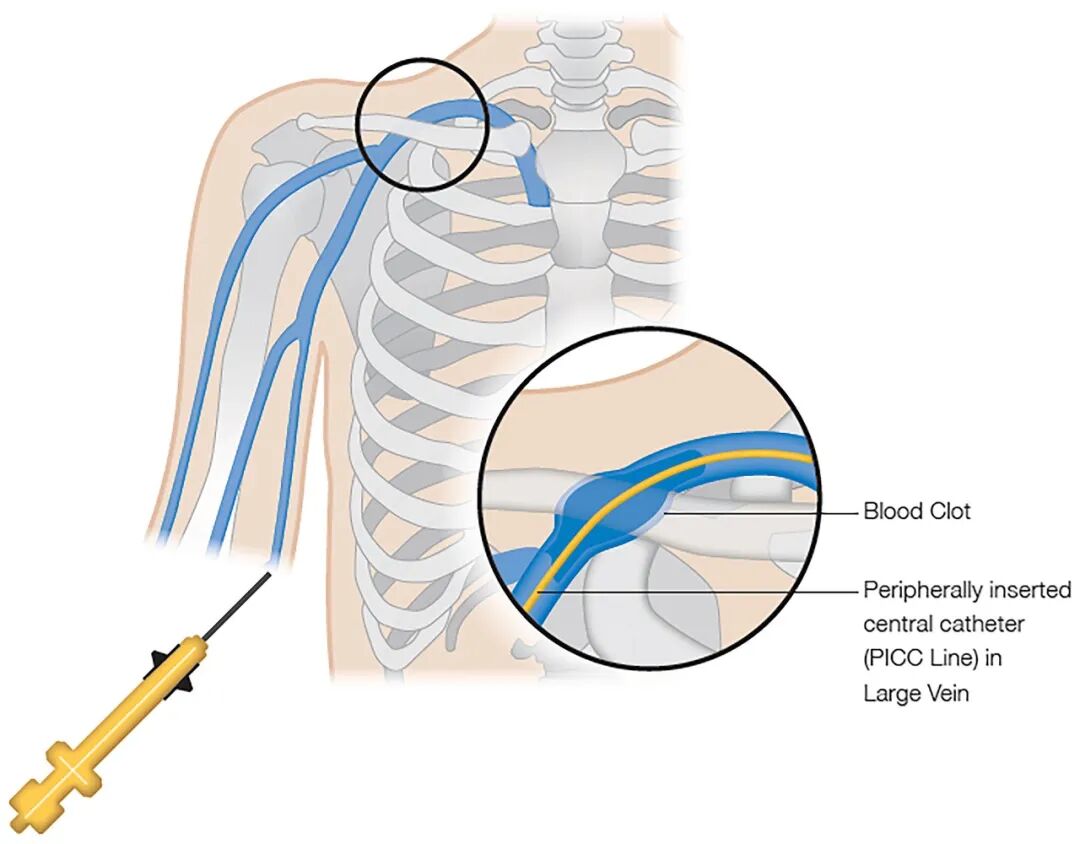 医学上ipc是什么米国静脉论坛上肢深静脉血栓临床指南与深度解析_https://www.jmylbn.com_新闻资讯_第18张