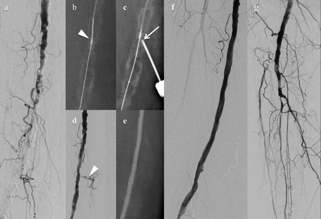 动脉钳怎么用动脉重度钙化导丝无法通过 针具技术超补救策略_https://www.jmylbn.com_新闻资讯_第12张