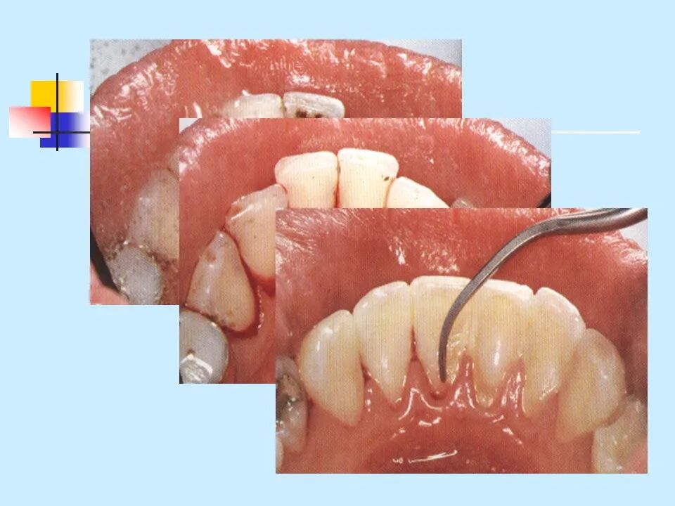 不得不知的治疗牙周炎的5种最有效方法！