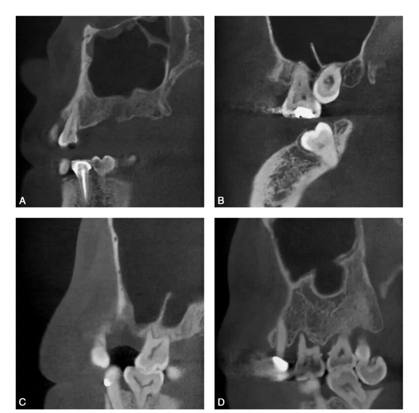 上颌骨CBCT影像图谱大全！值得收藏！