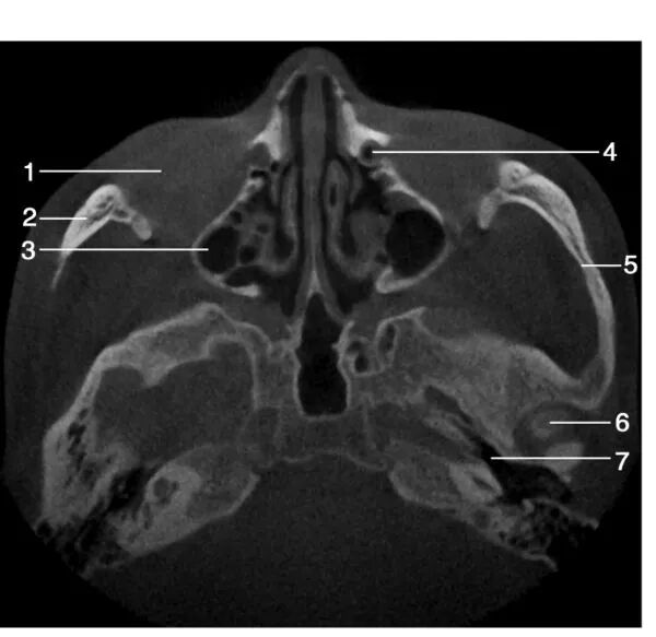 上颌骨CBCT影像图谱大全！值得收藏！