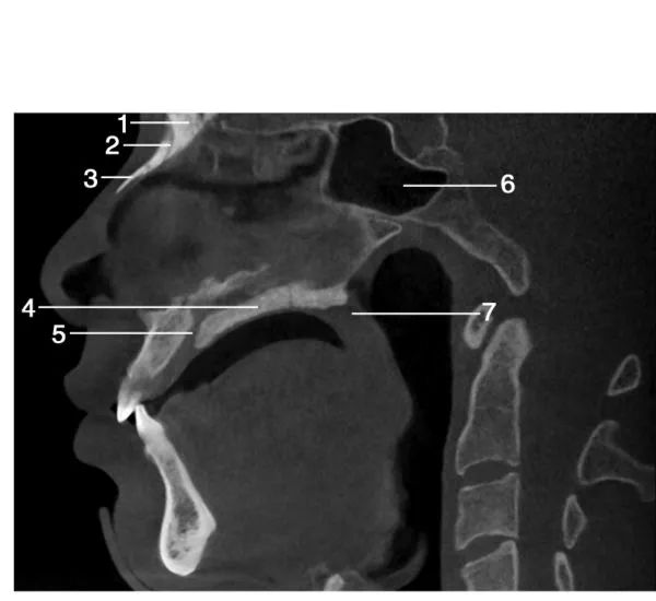 上颌骨CBCT影像图谱大全！值得收藏！