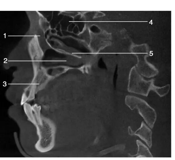 上颌骨CBCT影像图谱大全！值得收藏！