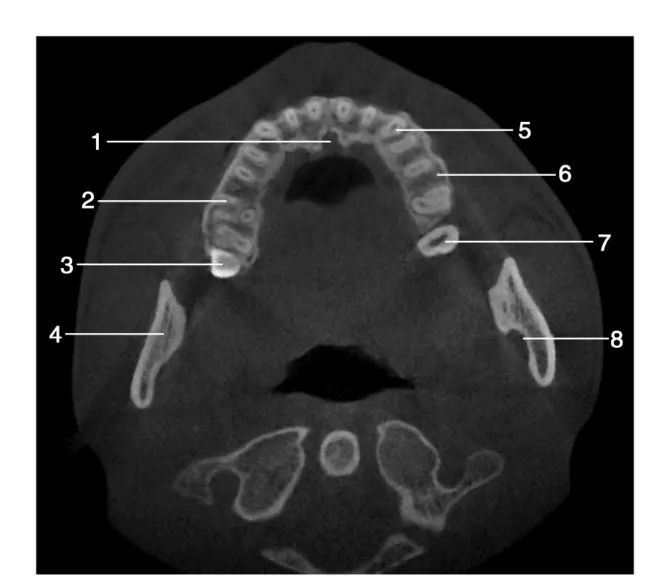 上颌骨CBCT影像图谱大全！值得收藏！
