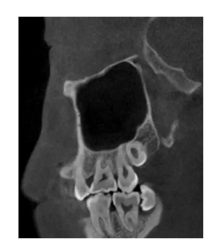 上颌骨CBCT影像图谱大全！值得收藏！