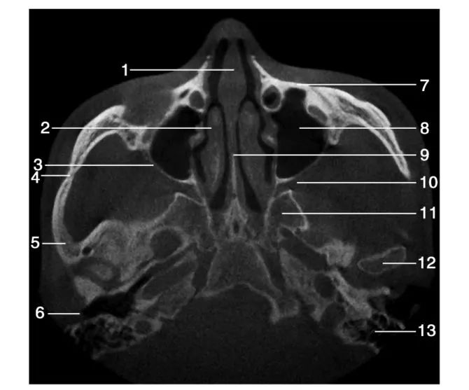 上颌骨CBCT影像图谱大全！值得收藏！