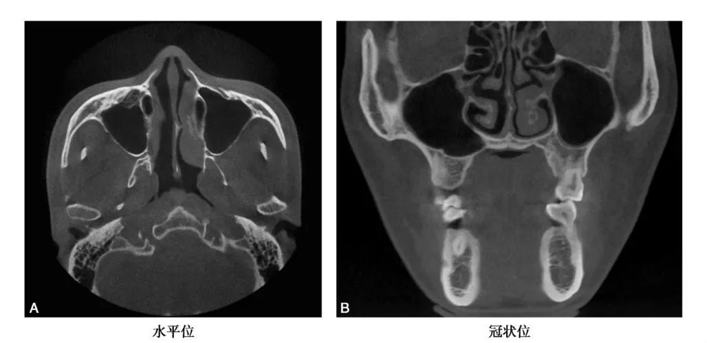 上颌骨CBCT影像图谱大全！值得收藏！