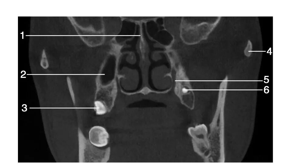 上颌骨CBCT影像图谱大全！值得收藏！