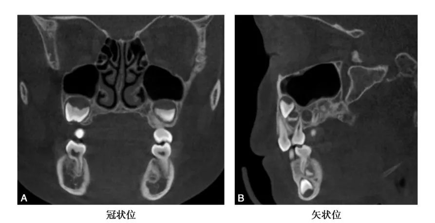上颌骨CBCT影像图谱大全！值得收藏！