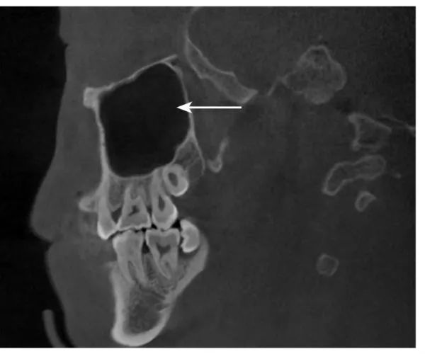 上颌骨CBCT影像图谱大全！值得收藏！