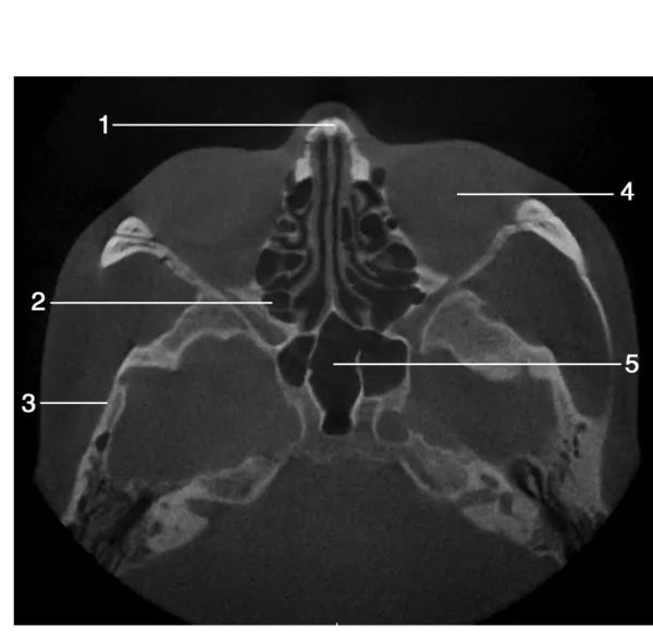 上颌骨CBCT影像图谱大全！值得收藏！