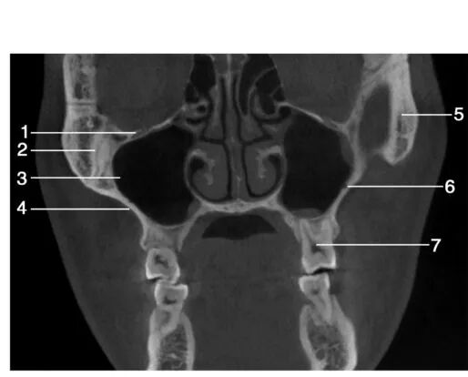 上颌骨CBCT影像图谱大全！值得收藏！