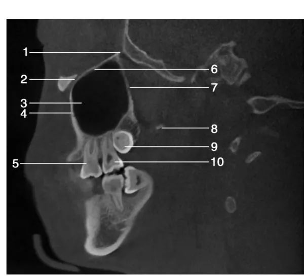 上颌骨CBCT影像图谱大全！值得收藏！