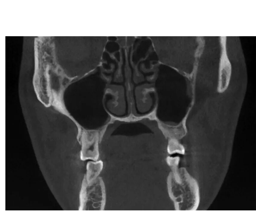 上颌骨CBCT影像图谱大全！值得收藏！