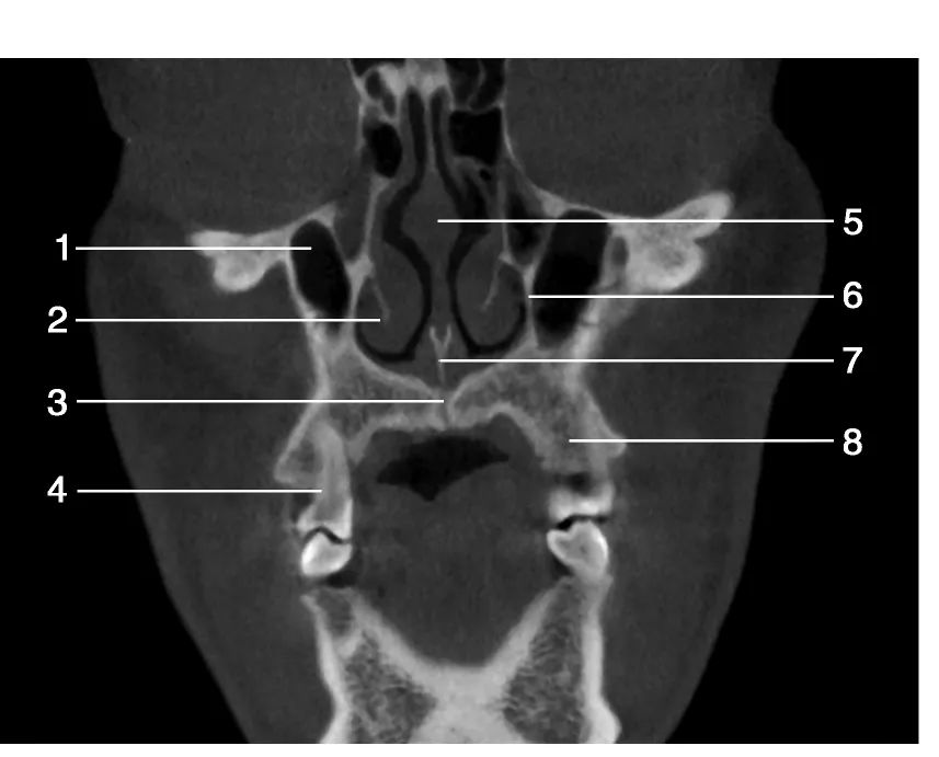 上颌骨CBCT影像图谱大全！值得收藏！