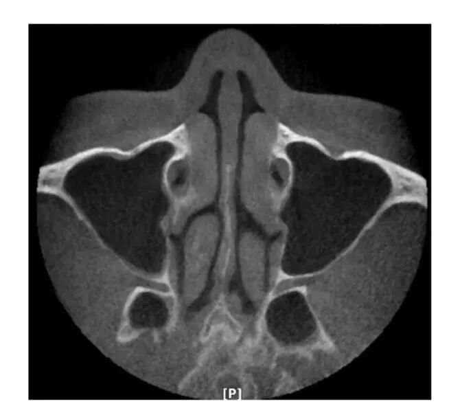上颌骨CBCT影像图谱大全！值得收藏！