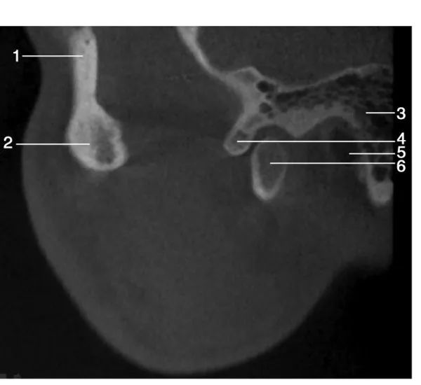 上颌骨CBCT影像图谱大全！值得收藏！