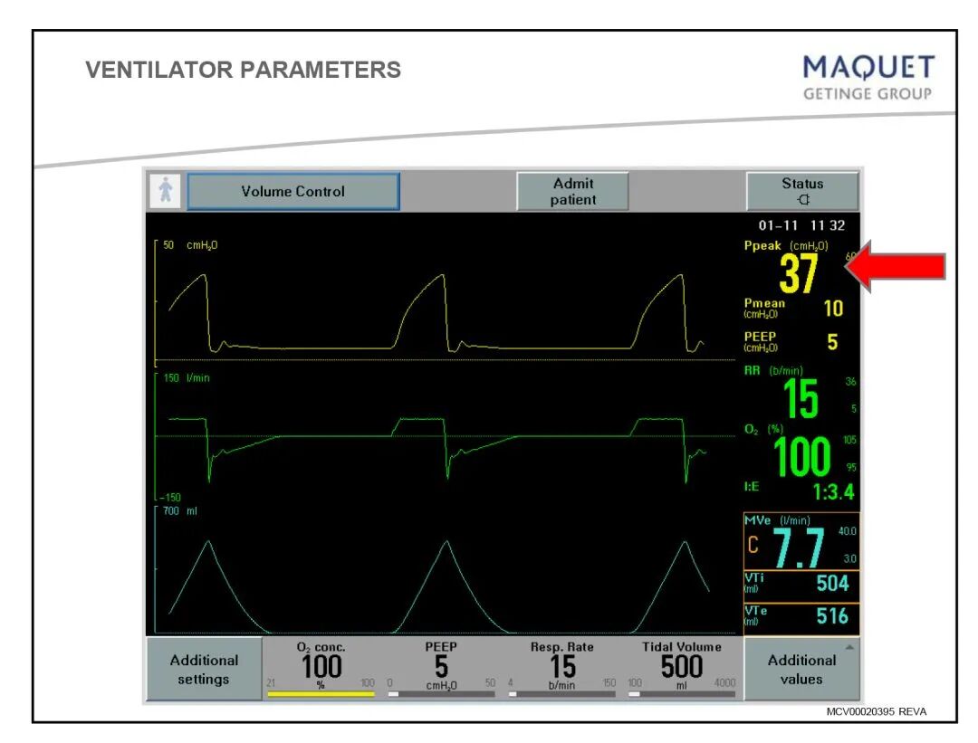 呼吸机呼吸用什么表示「基础篇」呼吸机模式及参数设置，快速上手！呼吸机操作入门，看这篇就够了_https://www.jmylbn.com_新闻资讯_第7张